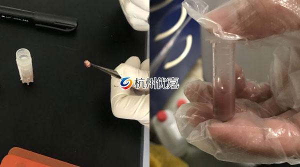 宋慈多样品组织研磨仪研磨人体肿瘤组织